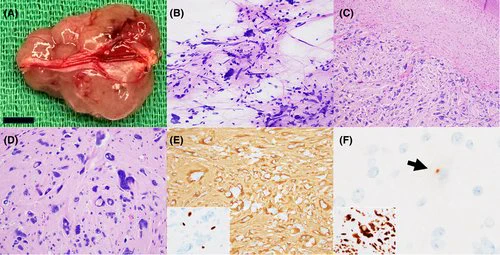 Gross examination revealed a circumscribed, lobular mass with attached segment of filum terminale (A, scale bar: 5 mm). Smear preparation revealed markedly pleomorphic nuclei and fibrillary cellular processes (B). Histologic evaluation revealed a circumscribed glial neoplasm composed of cells arranged in lobules and vague fascicles (C). Tumor cells were markedly pleomorphic with enlarged nuclei, hyperchromatic chromatin, and nuclear pseudoinclusions (D). By immunohistochemistry, the tumor cells were diffusely positive for GFAP (E), while Olig2 labeled only occasional interspersed cells (E, inset). EMA highlighted rare perinuclear dot-like positivity (F) and tumor cells were strongly positive for HOXB13 (F, inset).