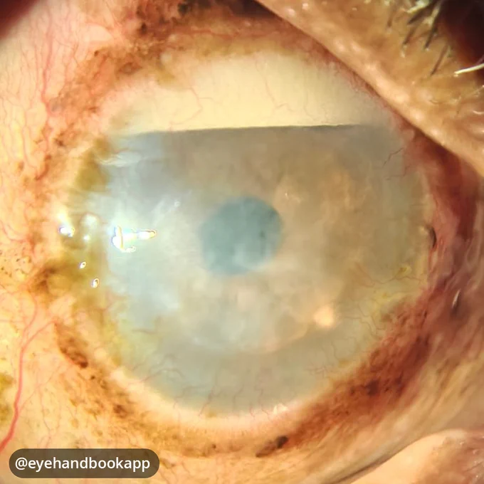 Patient came in with a complaint of pain in the eye for 5 months. This inverse hypopyon was missed in the previous examination done elsewhere. Always lift the lid!

Make your job as an eye care professional easier with the #free Eye Handbook mobile app! Access calculators, forums, references, and information in seconds, right from your smartphone or tablet.

Available on Android & iOS:
https://onelink.to/eyehandbookapp