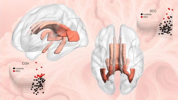 Illustration of a human brain with highlighted sections. Two brain areas, CGH and SCC, are emphasized in a pinkish-brown color. Nearby, graphs depict data points for "controls" and "MCI" groups, represented by black and red dots, respectively. The background is a subtle, abstract wave pattern.