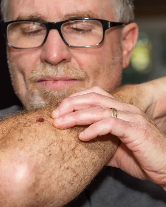 A person with glasses is examining a small, raised spot on their arm. They are gently touching the area with the other hand. The background is out of focus.