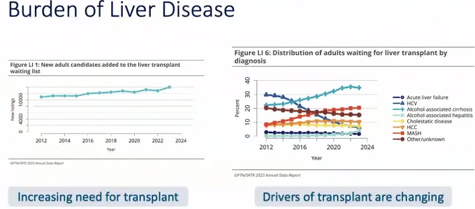 Graphic from Dr Helzbergs presentation titled "Burden of Liver Disease" that depicts a graph showing the increasing need for transplant and another graphic representing the changes of drivers of transplants over the course of the years he has been at Duke, since 2012. 