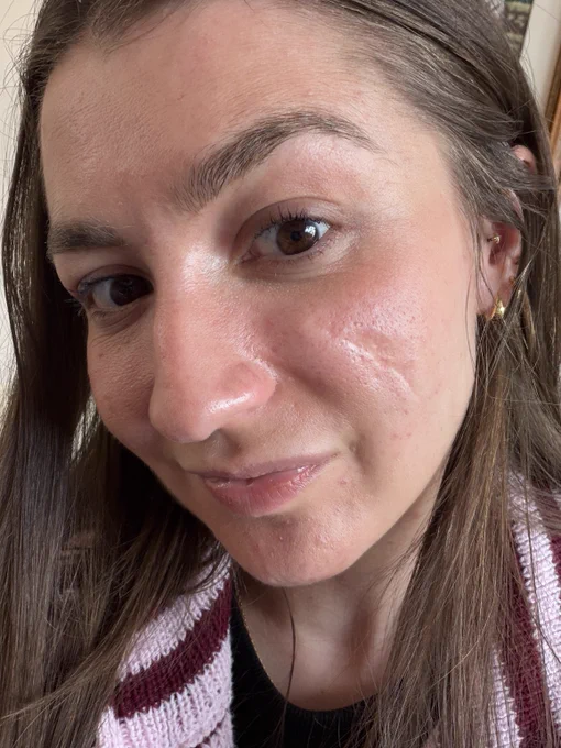 A white woman with long brunette hair takes a selfie, standing close to the camera and tilting her head to the side to highlight a scar on her cheek