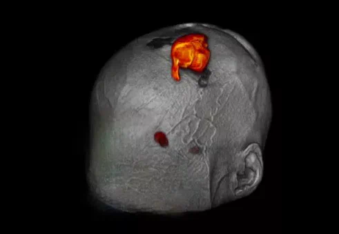 MRI scan of a human head showing highlighted areas of brain activity.