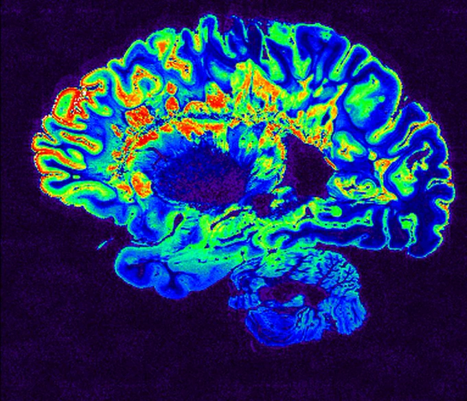 This is a pseudo-colored image using blue, green, yellow, and red shades of high-resolution gradient-echo MRI scan of a fixed cerebral hemisphere from a person with multiple sclerosis.