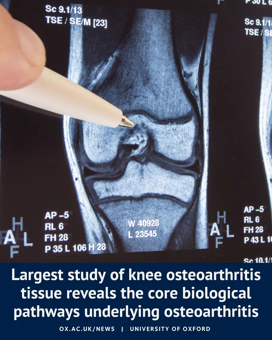 Magnetic resonance imaging (MRI) scan of a human knee displayed on a medical screen. A hand holding a white pen points to the centre of the knee joint, highlighting an area of interest. A dark blue banner at the bottom contains the text: “Largest study of knee osteoarthritis tissue reveals the core biological pathways underlying osteoarthritis” alongside University of Oxford branding.