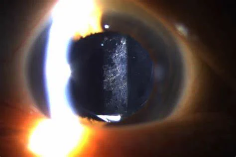 YAG eye treatment close up