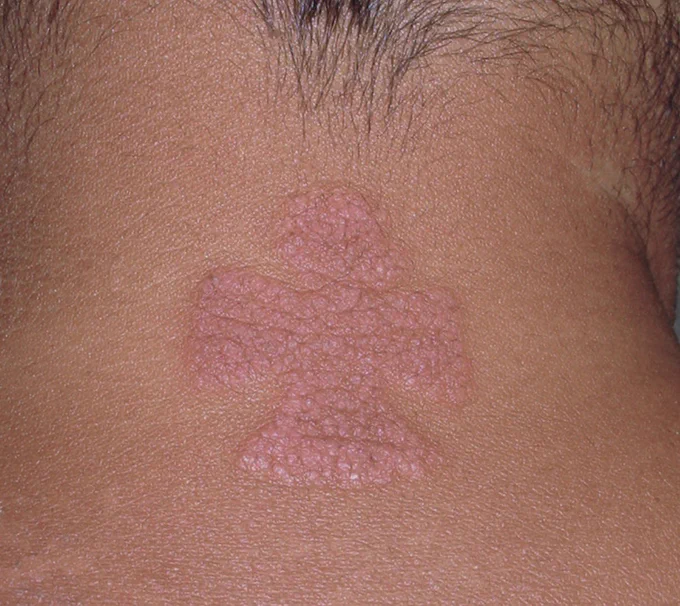 The shape of the lesion clearly suggests an exogenous insult/ etiology.
