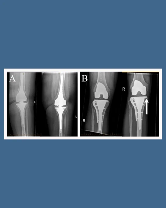 Images depict day one postoperative and fnal follow-up radiographs:
a) Rotating hinge prosthesis at the six-year follow-up showing integration and no subsidence
b) posterior stabilized prosthesis at 12 months follow-up showing a radiolucent line at the tibial baseplate illustrated by the arrow
