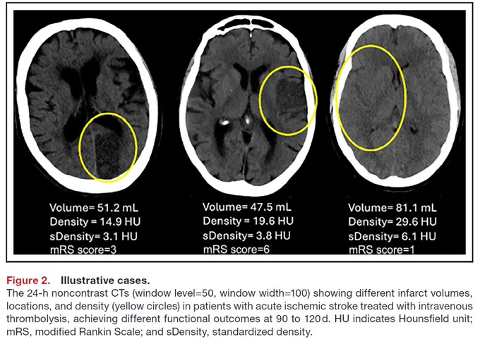 Illustrative examples of cases with different volumes and infarct densities showing how smaller infarcts can lead to worse outcomes when more hypodense, whereas larger infarcts can have good outcomes when less hypodense.