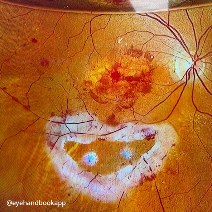 Make your job as an eye care professional easier with the #free Eye Handbook mobile app! Access calculators, forums, references, and information in seconds, right from your smartphone or tablet.

Available on Android & iOS:
https://onelink.to/eyehandbookapp

#SubretinalHemorrhage #nAMD #MacularDegeneration #RetinaSpecialist #RetinaSurgery #Ophthalmology #EyeHealth #VisionCare #RetinaCare #MedicalCase #ClinicalCase #RetinalDisease #EyeSurgery #HealthcareProfessionals #VisionScience #Photoreceptors #RPE #OcularHealth #MedicalEducation #EyeCare