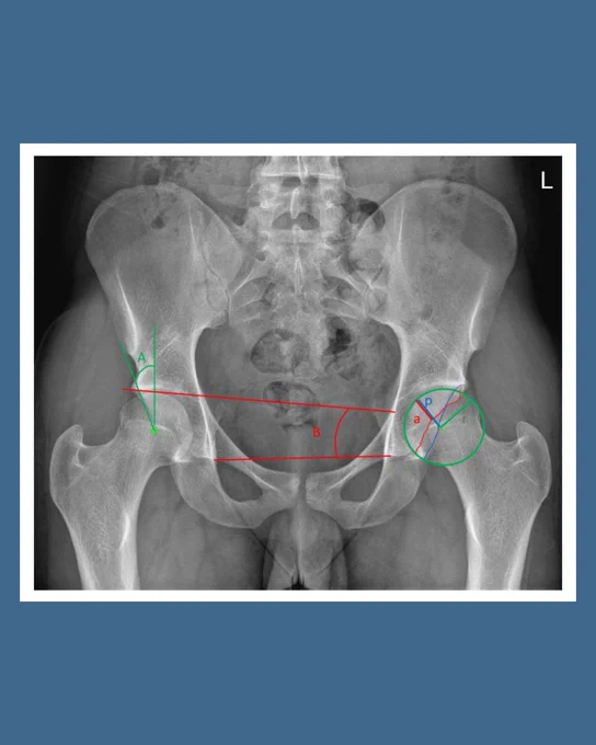 Image depicts anonymized anteroposterior pelvic radiograph showing lateral centre-edge angle (A), acetabular index (B), anterior wall index (a/r), and posterior wall index.

