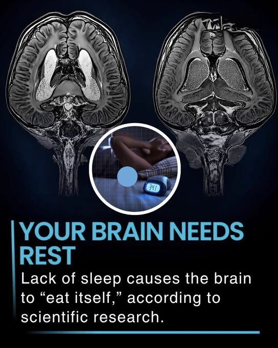 🚨 Your Brain Changes When You Don’t Sleep 

Scientists discovered that chronic sleep deprivation may cause certain brain cells to become overactive and start breaking down healthy brain connections. Long-term sleep loss has also been linked to memory problems, anxiety, depression, and even higher risk of Alzheimer’s disease.

Sleep is not wasted time… it’s your brain’s repair system. 
Adults are advised to get 7–9 hours of sleep each night.

Source 
Bellesi, M., de Vivo, L., Chini, M., Gilli, F., Tononi, G., & Cirelli, C. “Sleep Loss Promotes Astrocytic Phagocytosis and Microglial Activation in Mouse Cerebral Cortex.” Journal of Neuroscience.