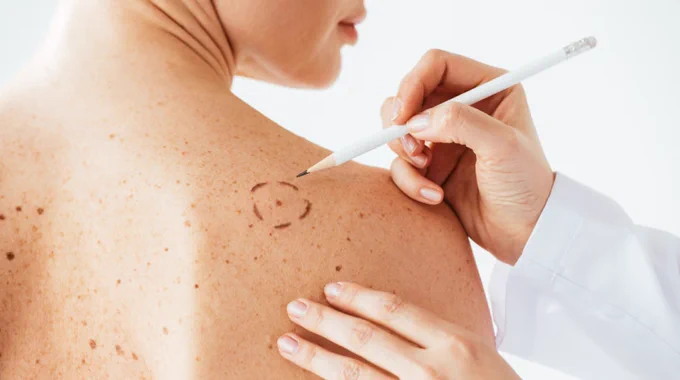 A person with freckles and moles on their back is examined. Another person uses a white pencil to circle an area on the skin.