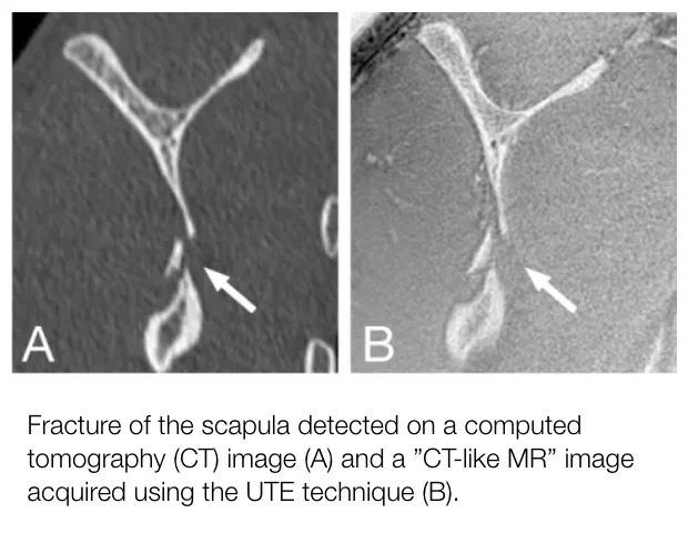 CT and MRI images of a scapula fracture. Image A shows the fracture on a CT scan, marked by an arrow. Image B displays a similar view using a "CT-like MR" image obtained with the UTE technique, also marked by an arrow.