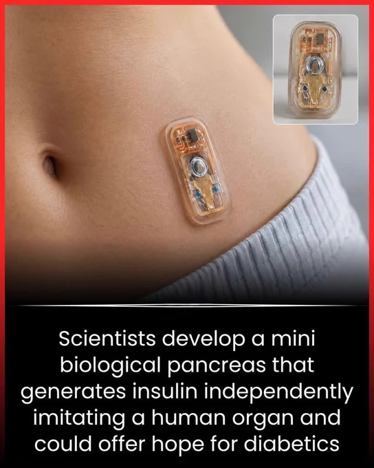 🚨 SCIENTISTS JUST CREATED A MINI PANCREAS THAT MAKES INSULIN ON ITS OWN 

What if people with diabetes no longer needed daily insulin injections in the future?

Scientists have now developed a tiny lab-grown “mini pancreas” that can naturally produce insulin just like a real human organ. The bioengineered cells can actually sense rising sugar levels and respond by releasing insulin automatically.

Researchers say this breakthrough could completely change the future of diabetes treatment. While it’s still being tested in laboratories and not yet ready for public use, experts believe this technology may one day help replace damaged organs with living lab-grown tissues.

A future where the body heals itself instead of depending on constant medication may be closer than we think… and this could be one of the biggest medical breakthroughs of our time. 

Source): National Institute of Diabetes and Digestive and Kidney Diseases. Bioartificial pancreas and regenerative medicine