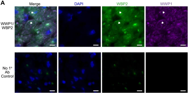 Co-localization and interaction of endogenous WWP1 and WBP2 in human heart. Endogenous co-localization of a subset of cellular WWP1 (purple) and of WBP2 (green) in paraffin sections of human ventricles by co-immunofluorescence (A). Nuclei were counterstained with DAPI (blue). Signal overlap was detected in puncta beneath the sarcolemma (white arrowheads). Scale bars: 10 µm. To determine whether there might be endogenous interaction between the proteins, PLA was performed on two independent sources of cardiac tissue.