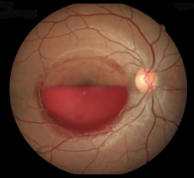 Valsalva Retinopathy

A 28-year-old male presented with a history of rigorous exercise in the gym followed by sudden loss of vision. On examination, he was found to have a pre-retinal hemorrhage.

