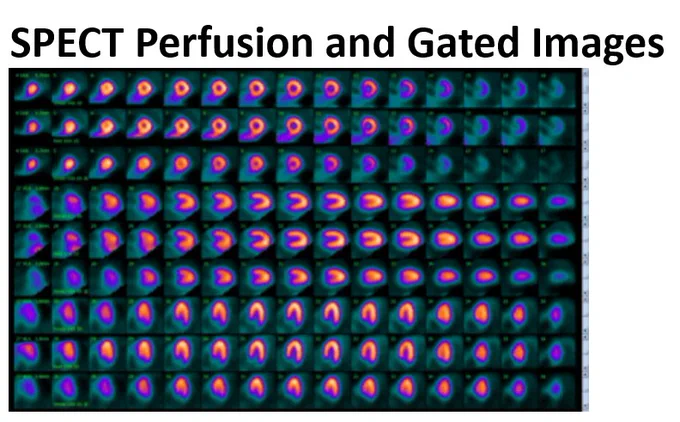 SPECT perfusion and gated images 