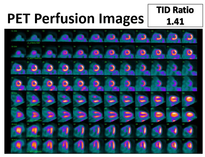 PET perfusion images; TID ratio: 1.41