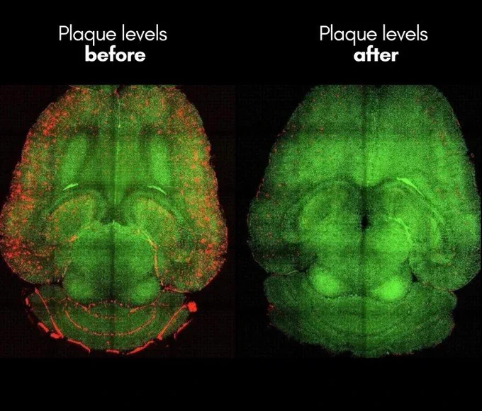 🚨: A new "super-drug" reverses memory loss by removing Alzheimer's plague, an astonishing breakthrough!