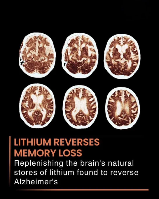 🧠 SCIENTISTS MAY HAVE FOUND A SURPRISING WAY TO REVERSE MEMORY LOSS

What if one tiny element already found in the brain could help fight Alzheimer's disease?

Researchers discovered that restoring natural lithium levels in the brain reversed memory loss and improved brain function in experimental studies. The findings suggest that a shortage of lithium may play a role in Alzheimer's, opening a new path for future treatments.

It's still early research, but the results are giving scientists fresh hope that memory loss may not always be permanent.

Source 
University of São Paulo. *Replenishing natural brain lithium levels reverses memory loss associated with Alzheimer's disease*.