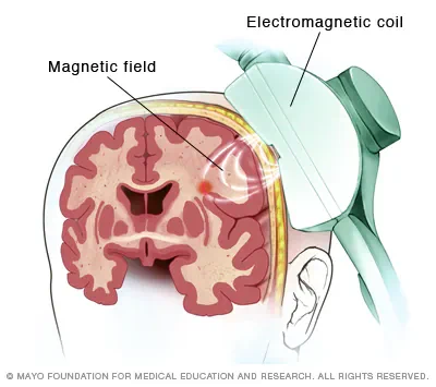 During an rTMS session for depression, an electromagnetic coil is placed against the scalp of your head. This coil delivers magnetic pulses that stimulate nerve cells in the region of your brain involved in mood control and depression. It's thought to activate regions of the brain that have decreased activity during depression.

(image and caption from the Mayo Clinic)
