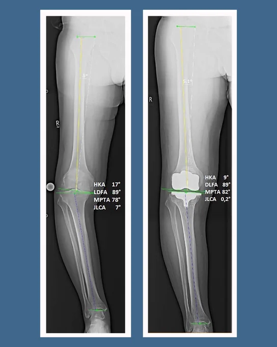 Left image depicts: Preoperative full weightbearing long-standing anteroposterior
radiograph of a varus knee with alignment references.

Right image depicts: Postoperative full weightbearing long-standing anteroposterior
radiograph of the knee in Figure 2 with alignment references.