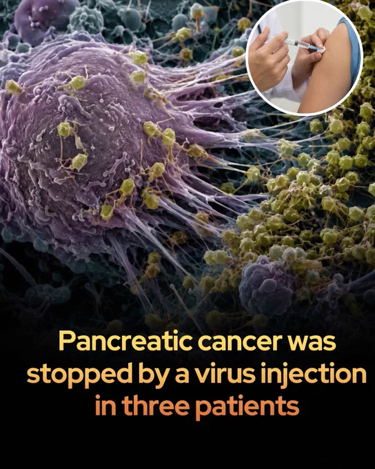 In a clinical trial, an engineered cancer-killing virus just eradicated pancreatic tumors in three patients.

It offers an unprecedented spark of hope against one of the world's deadliest cancers.

Pancreatic cancer has long been a medical nightmare, notoriously difficult to treat because it is rarely detected before spreading. However, a highly anticipated early-stage clinical trial has revealed that a tropism-modified, oncolytic virus can selectively target and dismantle these stubborn tumors.

 Injected directly into the pancreatic tumors of three patients, the engineered virus replicated inside the malignant cells, causing them to burst while simultaneously triggering a localized immune response. 

Remarkably, the treatment completely halted tumor growth and prevented any further spread of the disease.

What makes these early results particularly astonishing is that patients only received about one-tenth of the targeted therapeutic dose. 