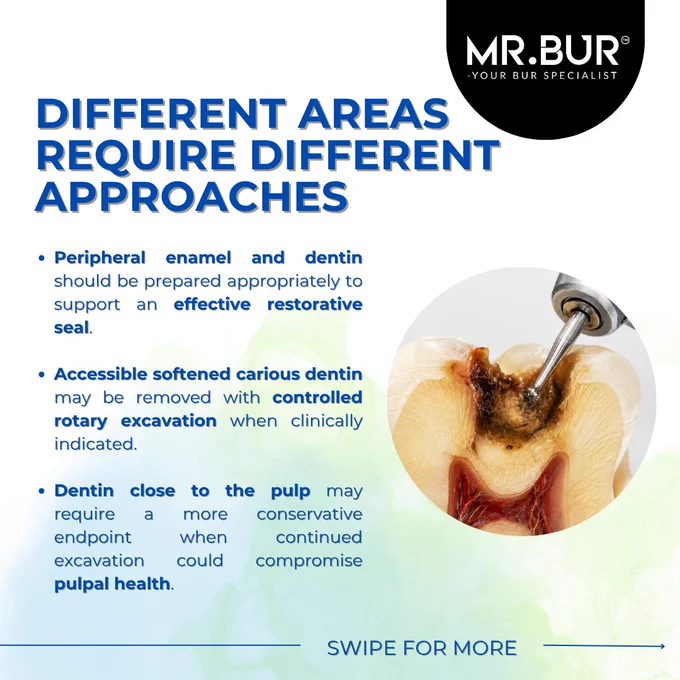 Round carbide bur approaching softened carious dentin during controlled deep caries excavation near the pulp