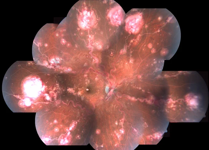 Retinal Capillary Hemangioma

This wide-field retinal image depicts numerous capillary hemangiomas in a 19-year-old male, seen as distinct reddish-pink vascular masses with prominent feeder vessels. The presence of surrounding exudates and fibrotic changes suggests long-standing disease. The photograph captures the characteristic features of retinal capillary hemangiomas, commonly linked to Von Hippel–Lindau syndrome.

