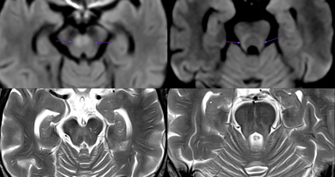 Axial MRI images through the caudal midbrain showing arrows pointing to a compact central crossing structure in the midbrain tegmentum.
