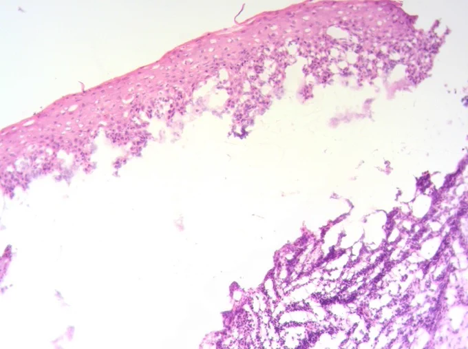 Histopathologic examination showing focal subepithelial clefting with predominantly neutrophilic inflammatory infiltrate and absence of significant eosinophils, favoring mucous membrane pemphigoid (H&E, ×100).  
