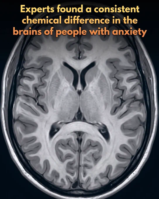 There’s a consistent chemical deficiency in the brains of individuals with anxiety.

A groundbreaking meta-analysis from UC Davis Health has identified a specific biological marker for anxiety: a significant reduction in choline levels within the prefrontal cortex. This brain region is critical for emotional control and decision-making. By analyzing data from hundreds of individuals with conditions like panic and social anxiety disorders, researchers found an average 8% drop in choline compounds. This discovery marks the first time scientists have identified a consistent chemical pattern in the brain across different types of anxiety, suggesting that the condition involves measurable physical changes rather than just psychological stress.

Choline is an essential nutrient found in common foods like eggs, salmon, and soybeans, yet many people do not consume enough of it to support optimal brain function. 
