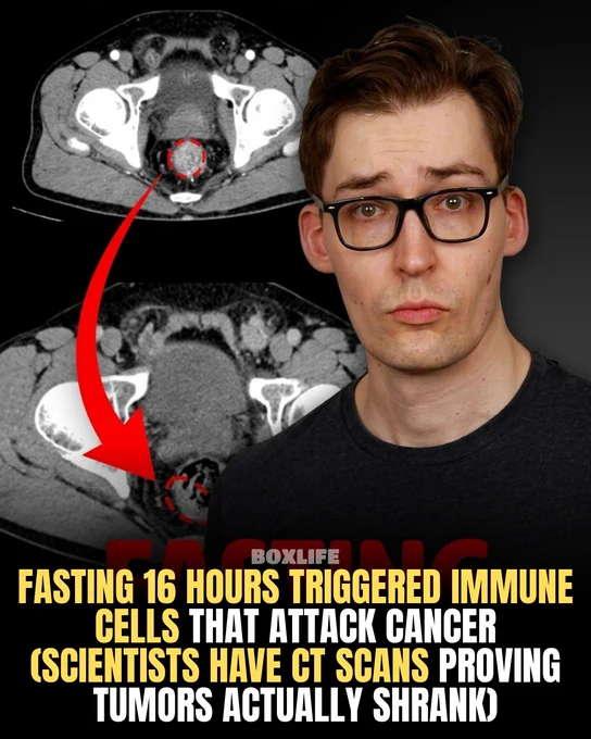 A man with glasses poses in front of CT scans showing tumor reduction. Text claims fasting triggers immune cells to attack cancer.