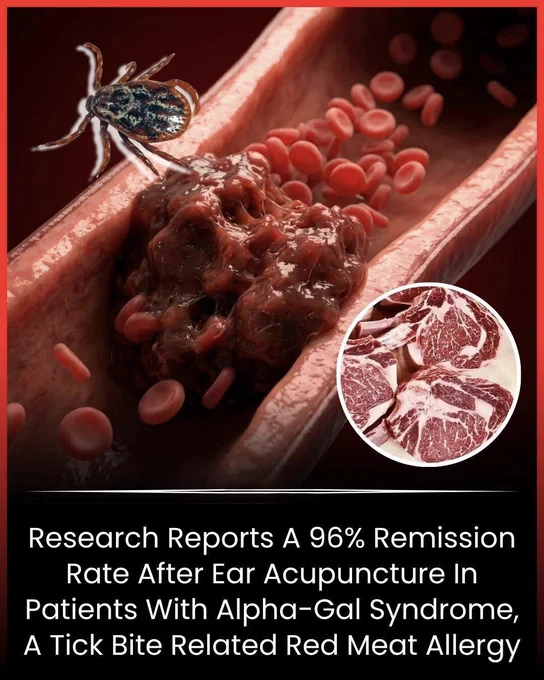 🚨 Could Tiny Needles Be the Secret to Beating a Meat Allergy? 
A surprising new study found that ear acupuncture helped 96% of people with Alpha-Gal Syndrome, a tick-bite-related allergy that can make red meat dangerous to eat.
Many participants reported major symptom relief, and some even regained the ability to eat foods that once triggered allergic reactions. While scientists say more research is needed, the results are raising hopes for a condition that currently has no widely accepted cure.
Sometimes the most unexpected discoveries come from the smallest places.
Source: Schofield, J. R., et al. Auricular acupuncture and remission of Alpha-Gal Syndrome.