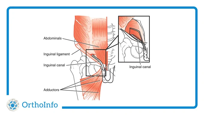 Illustration Showing Location of Sports Hernia (Athletic Pubalgia)
