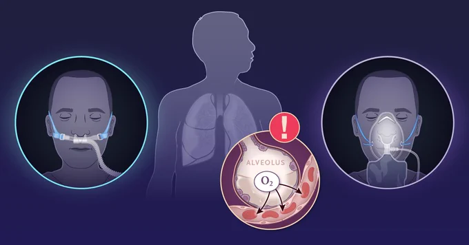 An illustration showing a patient receiving oxygen through nasal cannula on the left and standard oxygen on the right. In the center, there is a diagram highlighting acute hypoxemic respiratory failure with an oxygen (O2) symbol and an exclamation mark, positioned against a silhouette of lungs.