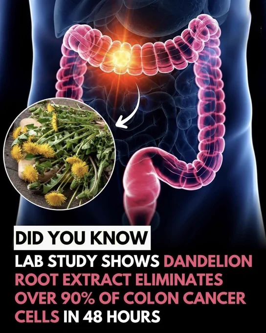 Scientists Found Something Surprising in a Common Weed

A plant many people consider a weed is catching scientists' attention. Laboratory studies found that dandelion root extract destroyed more than 90% of colon cancer cells within 48 hours while having little effect on healthy cells.

The discovery is exciting, but there’s a catch: these results were seen in the lab, not in humans. Researchers say more clinical studies are needed before dandelion root can be considered a cancer treatment.

Could a simple backyard plant hold a hidden medical secret? The science is still unfolding.

Source:
Ovadje, P., Hamm, C., Pandey, S., & others. *Evidence-Based Complementary and Alternative Medicine*.