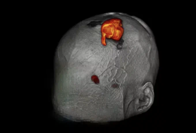 This image shows a 3D MRI brain scan with highlighted areas in orange and red, indicating specific brain regions of interest.