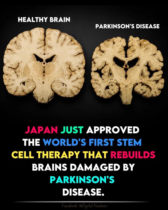 🚨 FIRST-EVER BRAIN REPAIR FOR PARKINSON'S? 

Japan has approved the world's first stem cell therapy for Parkinson’s disease. Scientists create new dopamine-producing brain cells in the lab and implant them into patients' brains to replace damaged cells. In early trials, patients showed improvements and brain scans confirmed the new cells were working.

For millions living with Parkinson’s, this could be the beginning of a new era of brain repair. 

Source
Sawamoto, N., et al. *Nature*. Kyoto University Center for iPS Cell Research and Application (CiRA); Sumitomo Pharma; Japan Ministry of Health.