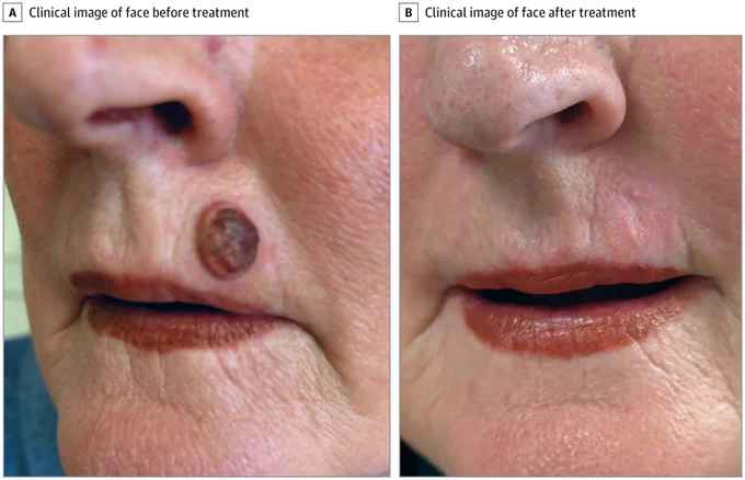 Side-by-side comparison: Before treatment (A), a dark, raised lesion is on the philtrum above the upper lip. After treatment (B), the lesion is gone, leaving a faint healed area. Lips are red-brown.