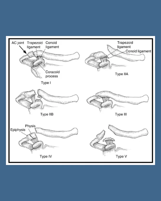 Image depicts diagrammatic representation of the modified Neer classification for distal third clavicle fractures