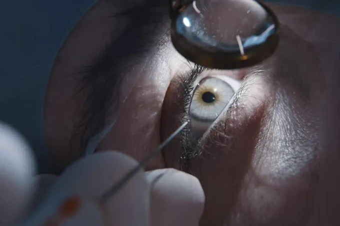 Extreme close-up of an eye during a refractive surgery examination, showing a magnifying lens and a fine medical instrument held by a gloved hand.