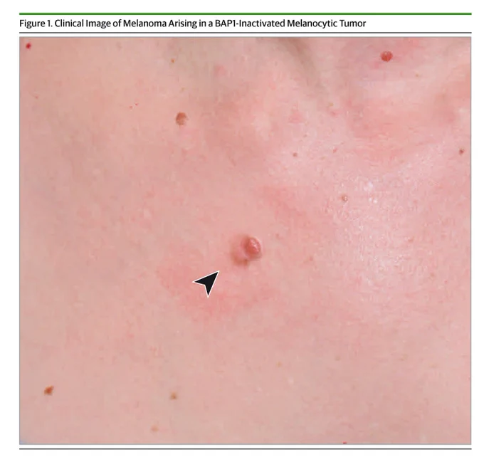 Figure 1. Clinical Image of Melanoma Arising in a BAP1-Inactivated Melanocytic Tumor. A close-up of light-toned skin shows multiple small moles and one raised, reddish-brown lesion with a black arrow pointing to it. The area around this lesion appears red and inflamed.