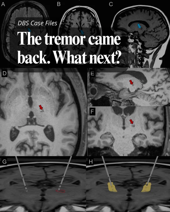 MRI scans showing brain regions with arrows highlighting areas related to tremor recurrence after DBS treatment. Text on graphic reads "DBS Case Files. The tremor came back. What next?"