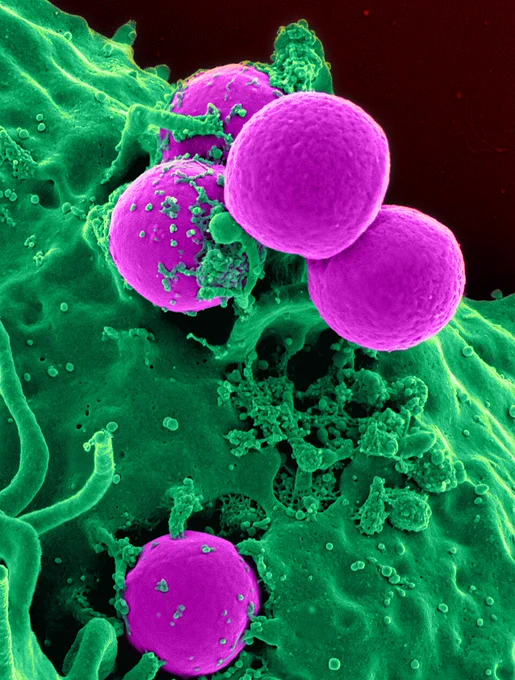 Colorized scanning electron micrograph of a human neutrophil ingesting MRSA.