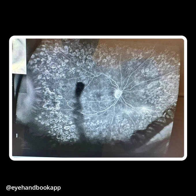 What is your diagnosis? 
#eyehealth #ophthalmology #eyecare #clinicalpearls #medicaleducation #eyeexam #hypopyon #uveitis #eyedoctor #ophthalmologist #patientcare #diagnosis #clinicalfindings #medicalcase #visioncare #eyeawareness #healthcareprofessionals #medicine #medicallearning