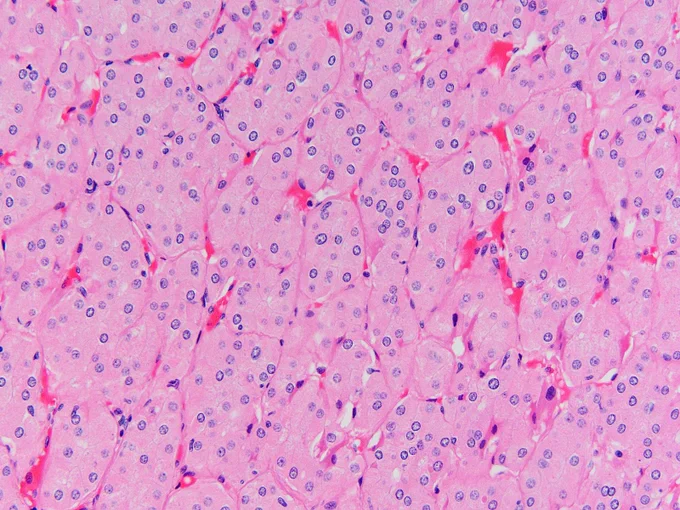 Solid growth of eosinophilic cells with bland, low-grade nuclei @IARCWHO