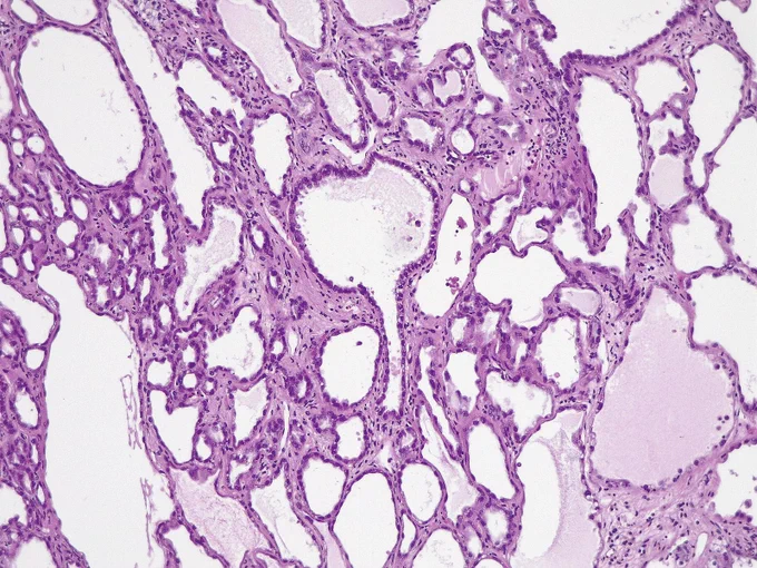 Small and intermediate-sized tubules and cysts @IARCWHO