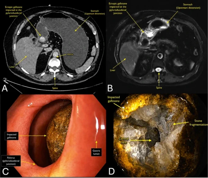 Overcoming Obstruction: Endoscopic Lithotripsy in Bouveret’s Syndrome